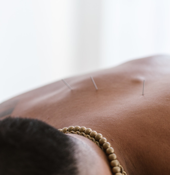 back pain acupuncture