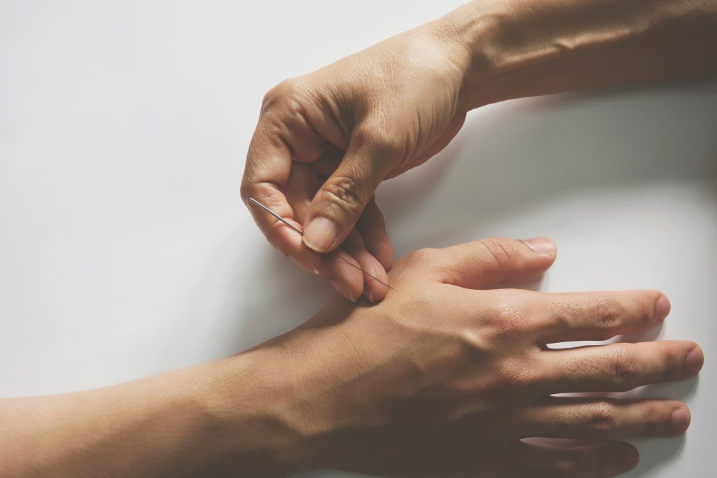 Acupuncture,Treatment,On,Patient,Hand.