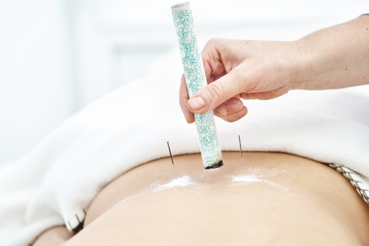Woman,Being,Treated,With,Acupuncture,And,Moxibustion,Treatments.,Moxibustion,Acupuncture